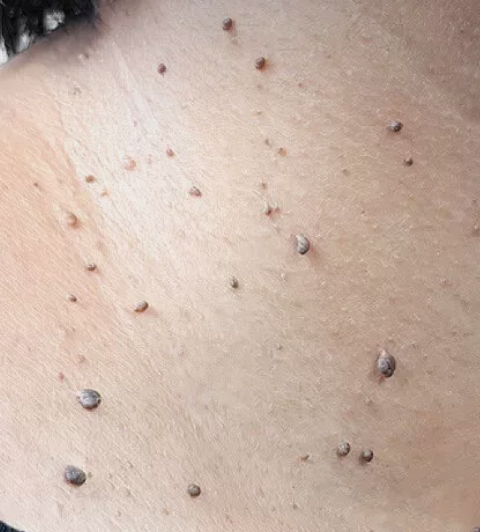 Plantar Warts and Skin Tags Disappear Naturally—Try This Overnight Remedy