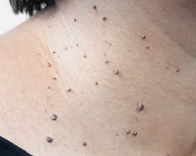 Plantar Warts and Skin Tags Disappear Naturally—Try This Overnight Remedy