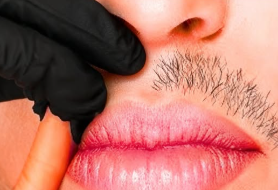 Tired of Shaving? Discover This Painless, Natural Hair Removal Trick Using Toothpaste and Onion