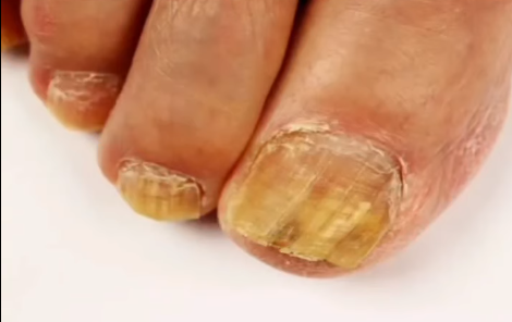 How to Grow Long, Strong Nails and Treat Nail Fungus with Baking Soda