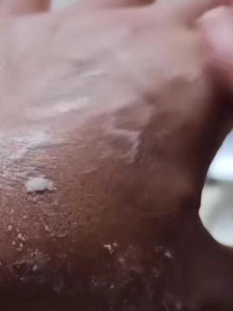 How to Remove Age Spots, Melasma, Sun Spots, Dark Marks, and Signs of Skin Aging Naturally