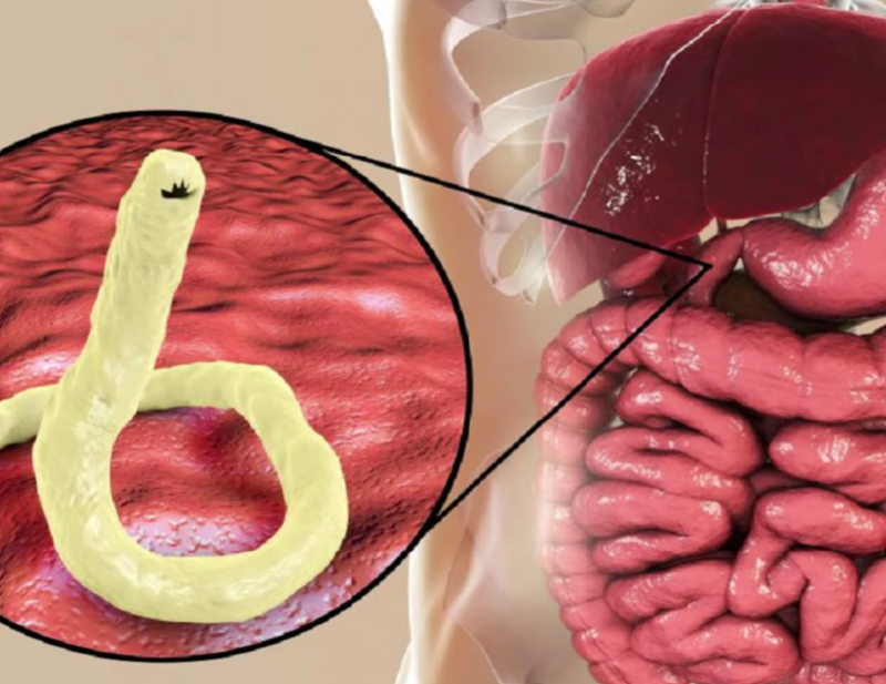 Remède naturel à base de plantes pour éliminer les parasites, les œufs intestinaux, les champignons et l’inflammation