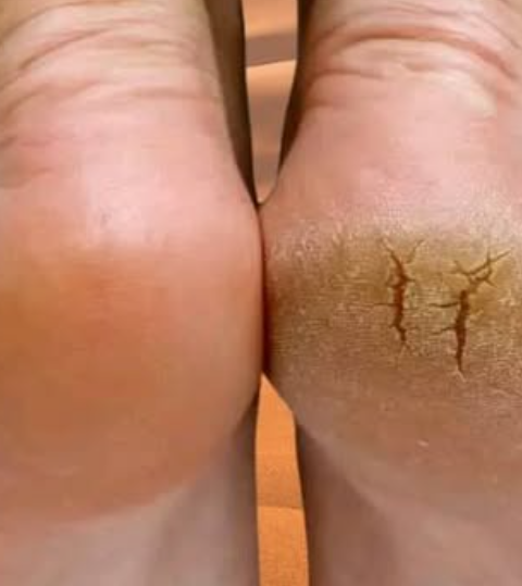 Just ONE Potato Can Help You Say Goodbye to Cracked Heels for Good