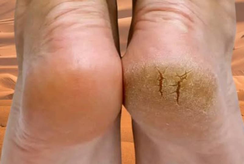 Just ONE Potato Can Help You Say Goodbye to Cracked Heels for Good