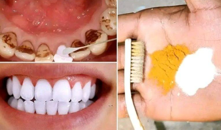 Home Teeth Whitening with Turmeric & Baking Soda: A Complete Guide
