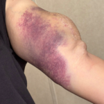 Apple Cider Vinegar Foot Soak: Benefits, Risks & What Science Says