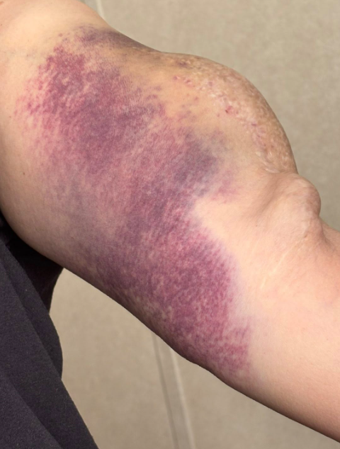 Unexplained Bruising? What It Could Mean and When to See a Doctor