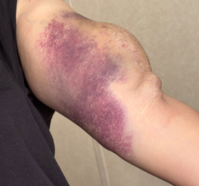 Unexplained Bruising? What It Could Mean and When to See a Doctor
